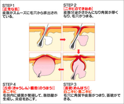 ニキビができるまで