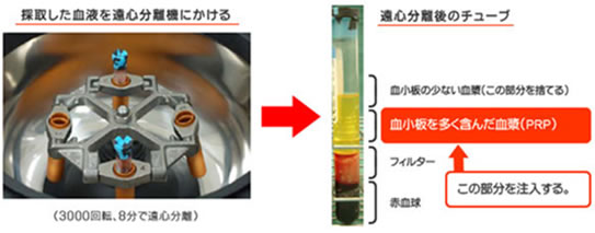 血漿作製方法